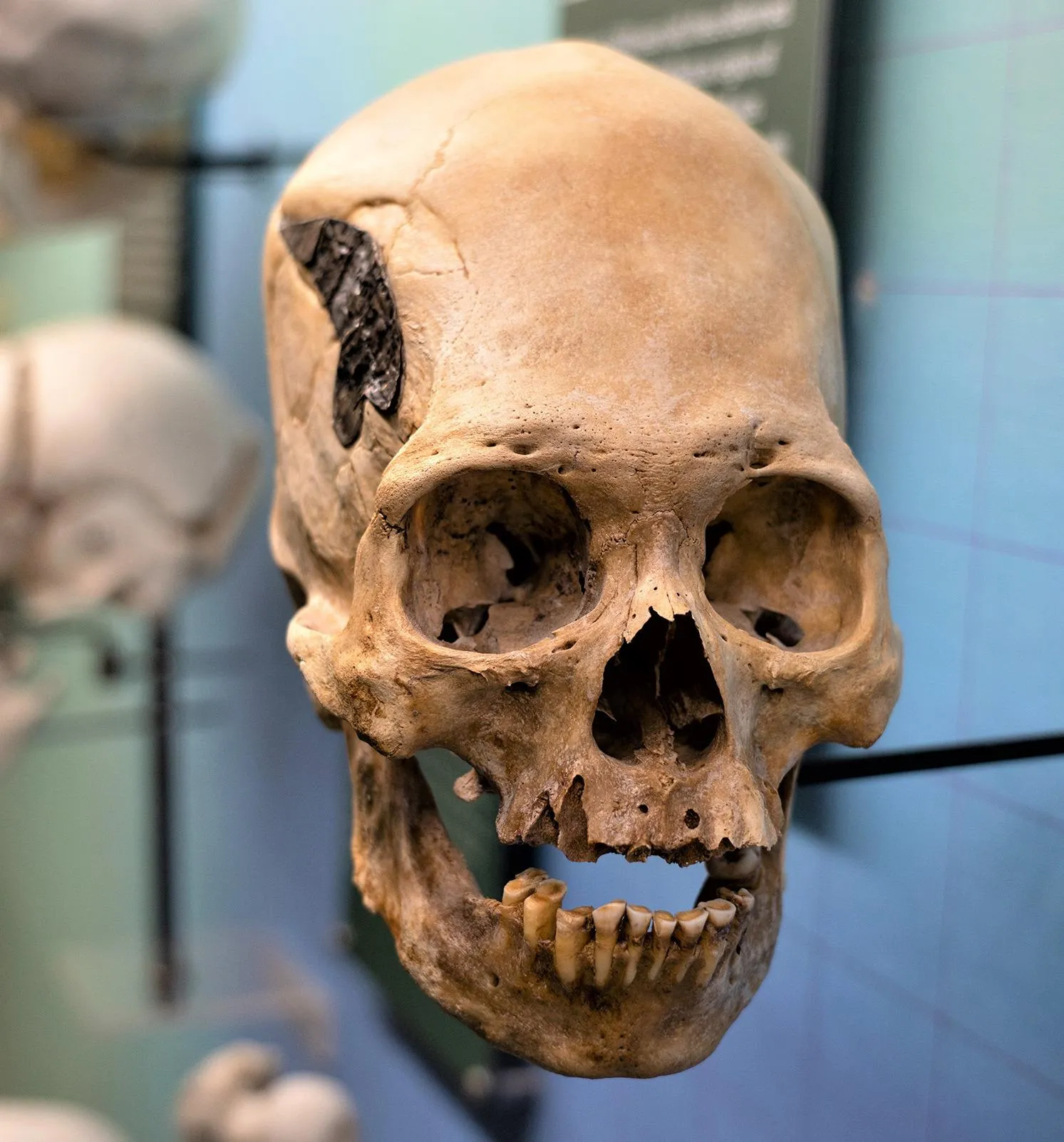 Череп перуанця з металевою пластиною Череп перуанця з металевою пластиною