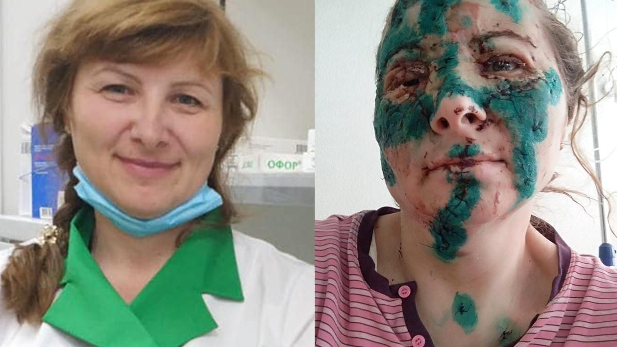 Харківська фармацевтка отримала жахливі травми обличчя через обстріли росіян - 24 Канал