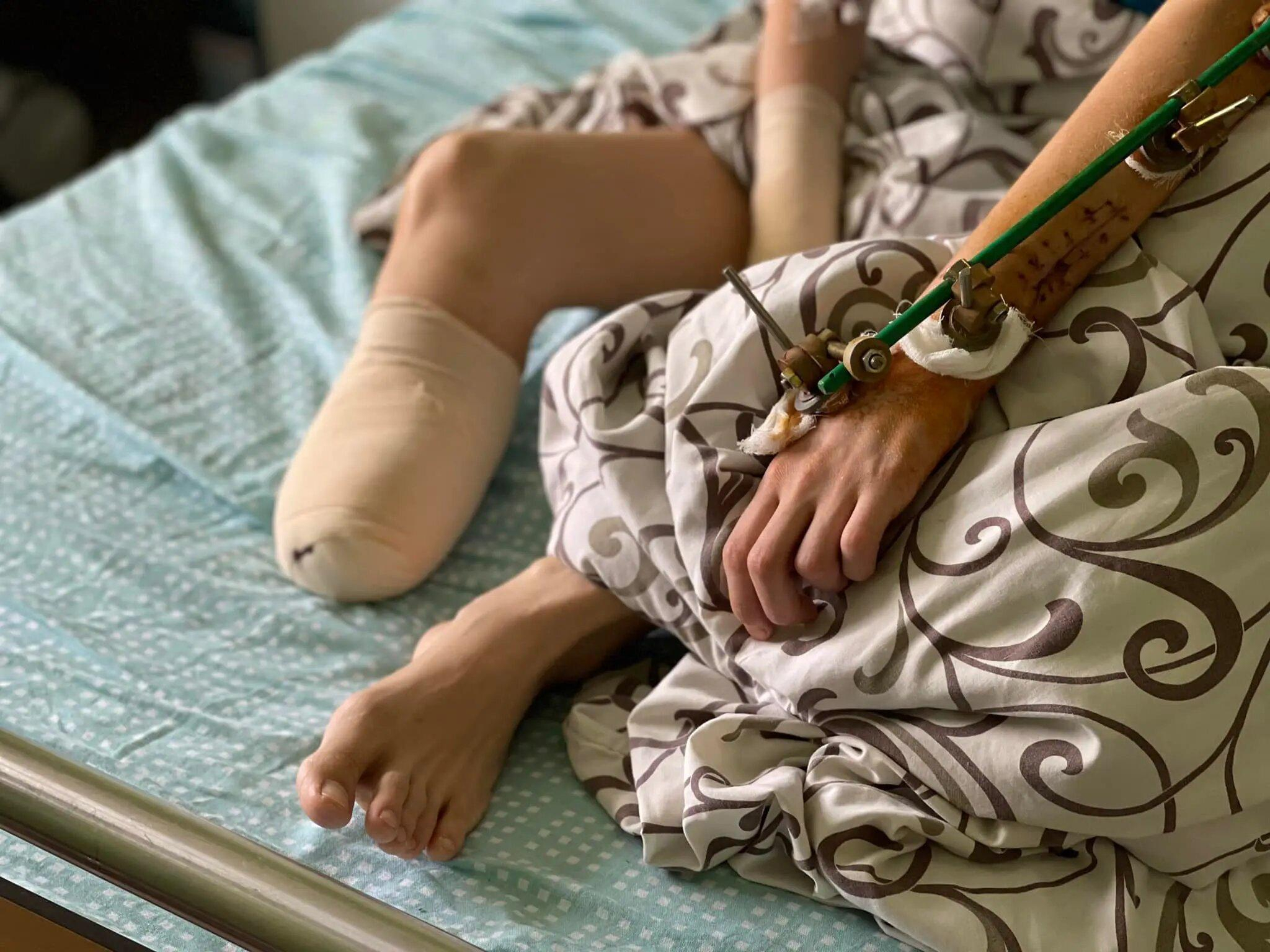 Більшість потребує протезування, – львівський хірург розповів про постраждалих з гарячих точок