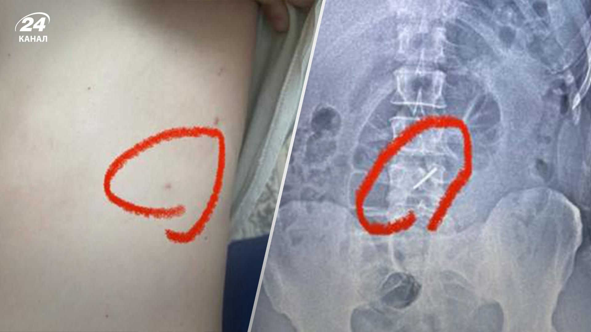 Украинский военный почти месяц воевал со сломанным хребтом Украинский военный почти месяц воевал со сломанным хребтом