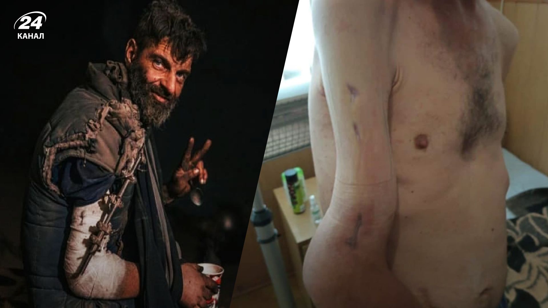 У Дианова не срослась раненая рука У Дианова не срослась раненая рука