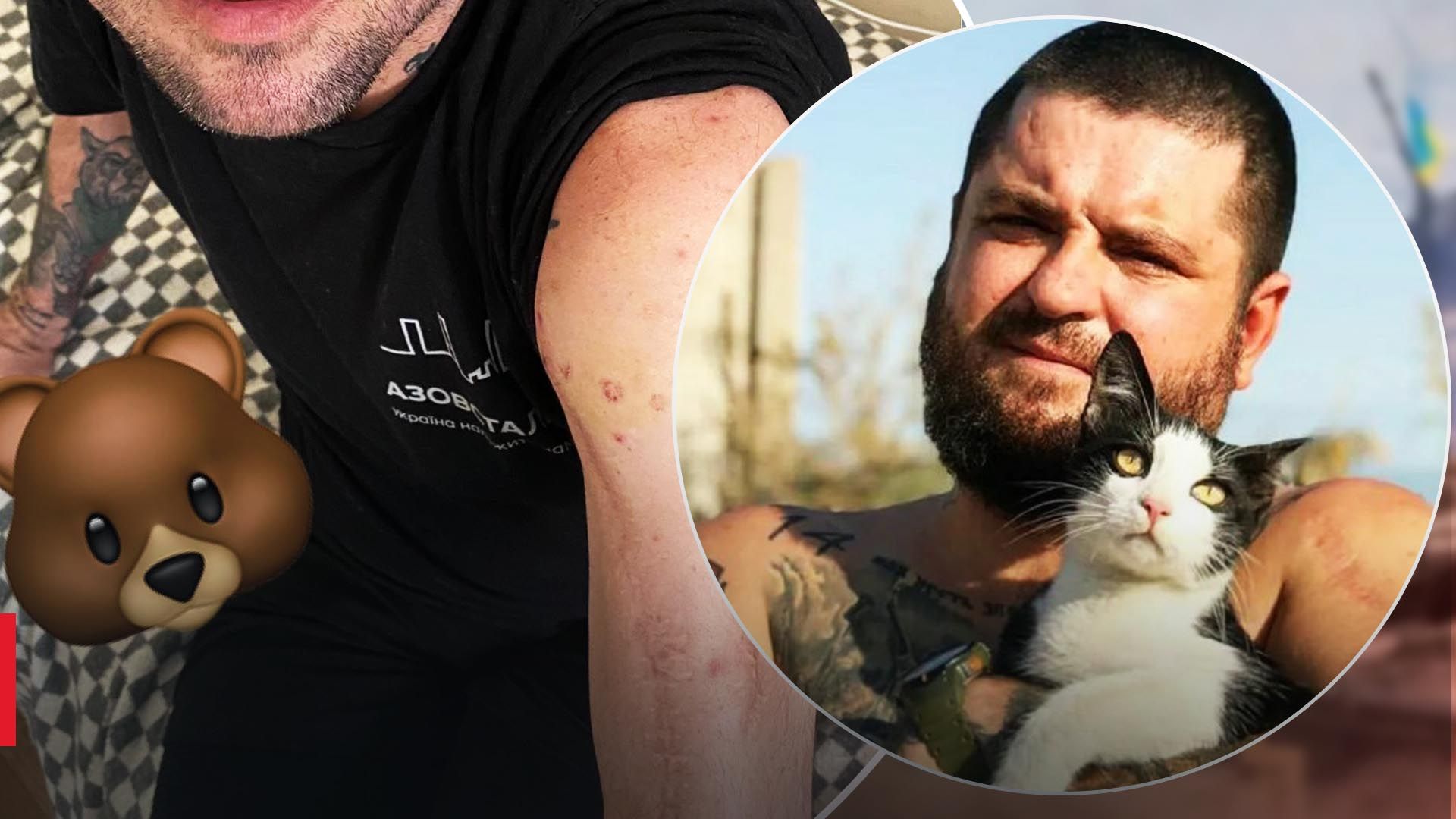 Александру "Медведю" Кравцову в плену сломали руку, которую едва собрали после ранения в ДАП Александру "Медведю" Кравцову в плену сломали руку, которую едва собрали после ранения в ДАП