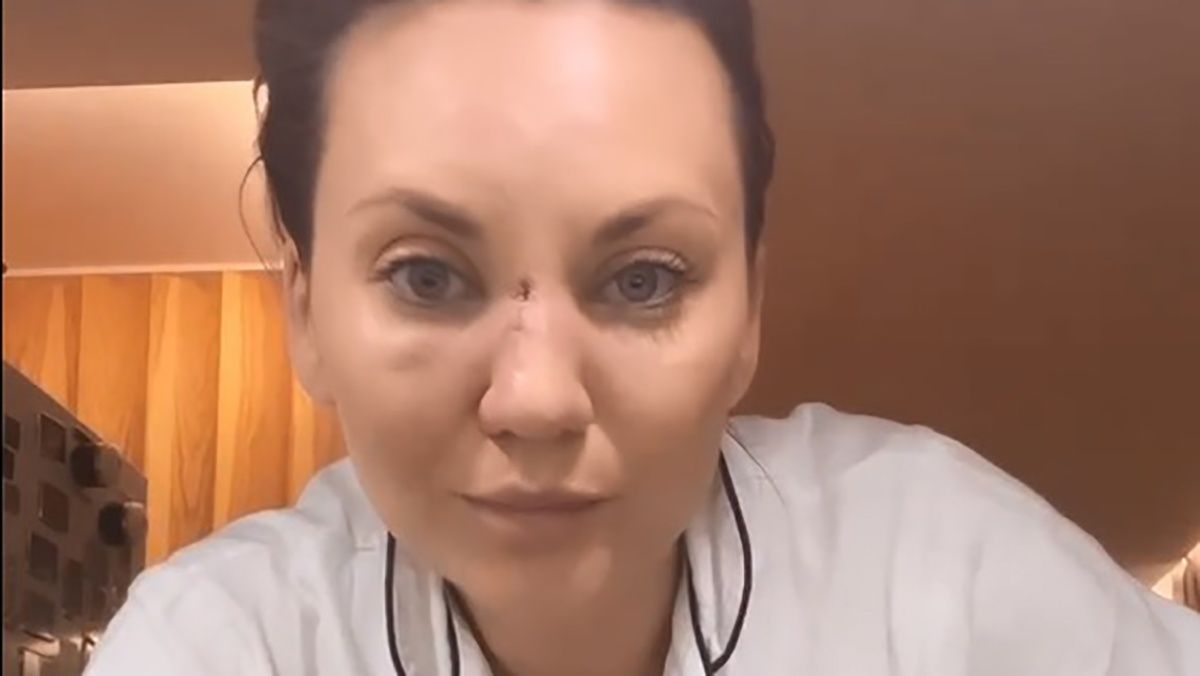 Анна Саліванчук послизнулася та зламала ніс – як вона виглядає – фото