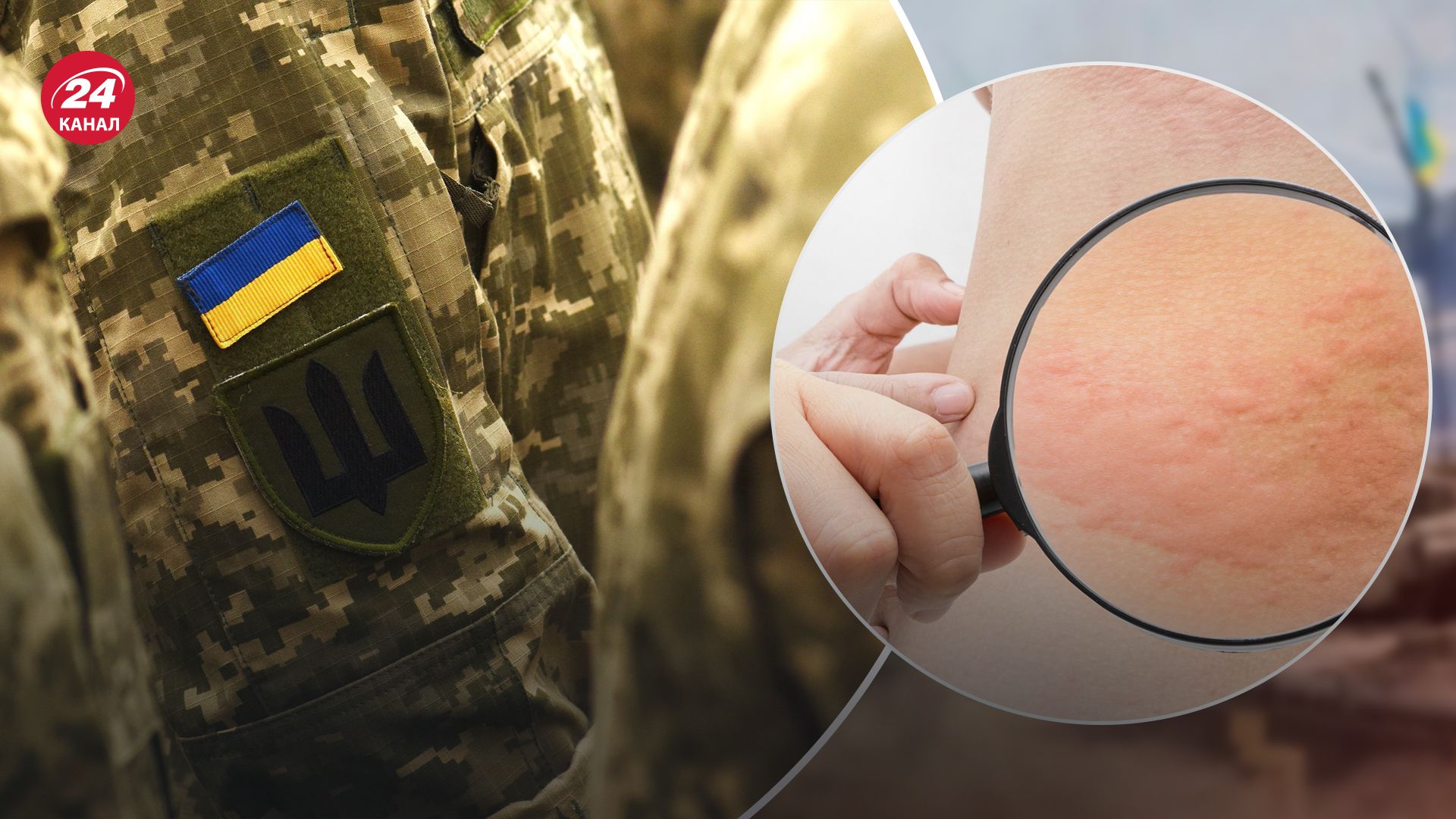 Из-за каких болезней кожи могут не призвать в армию Из-за каких болезней кожи могут не призвать в армию