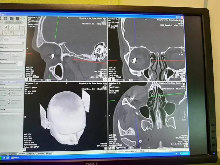 в оці оборонця Маріуполя був уламок довжиною 1 см в оці оборонця Маріуполя був уламок довжиною 1 см