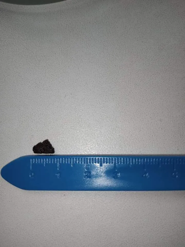 Уламок довжиною 1 см пробув рік в оці оборонця Маріуполя Уламок довжиною 1 см пробув рік в оці оборонця Маріуполя