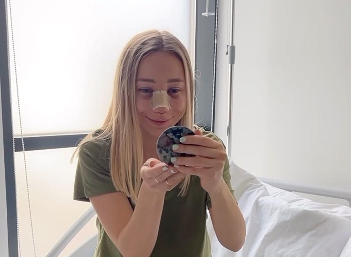 Катерина Реп'яхова зробила ринопластику