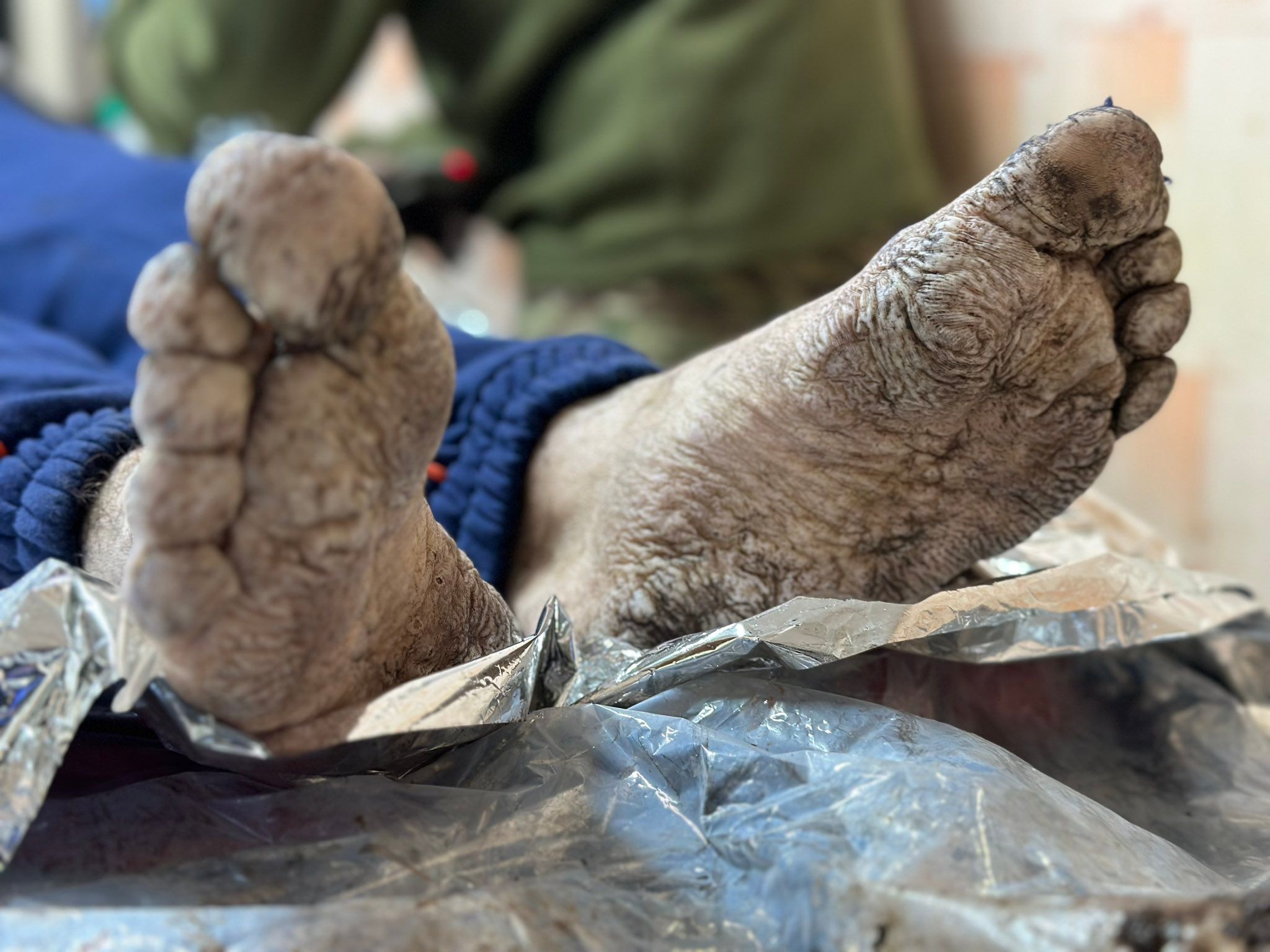 Алина Михайлова показала жуткие фото "окопной болезни" Алина Михайлова показала жуткие фото "окопной болезни"