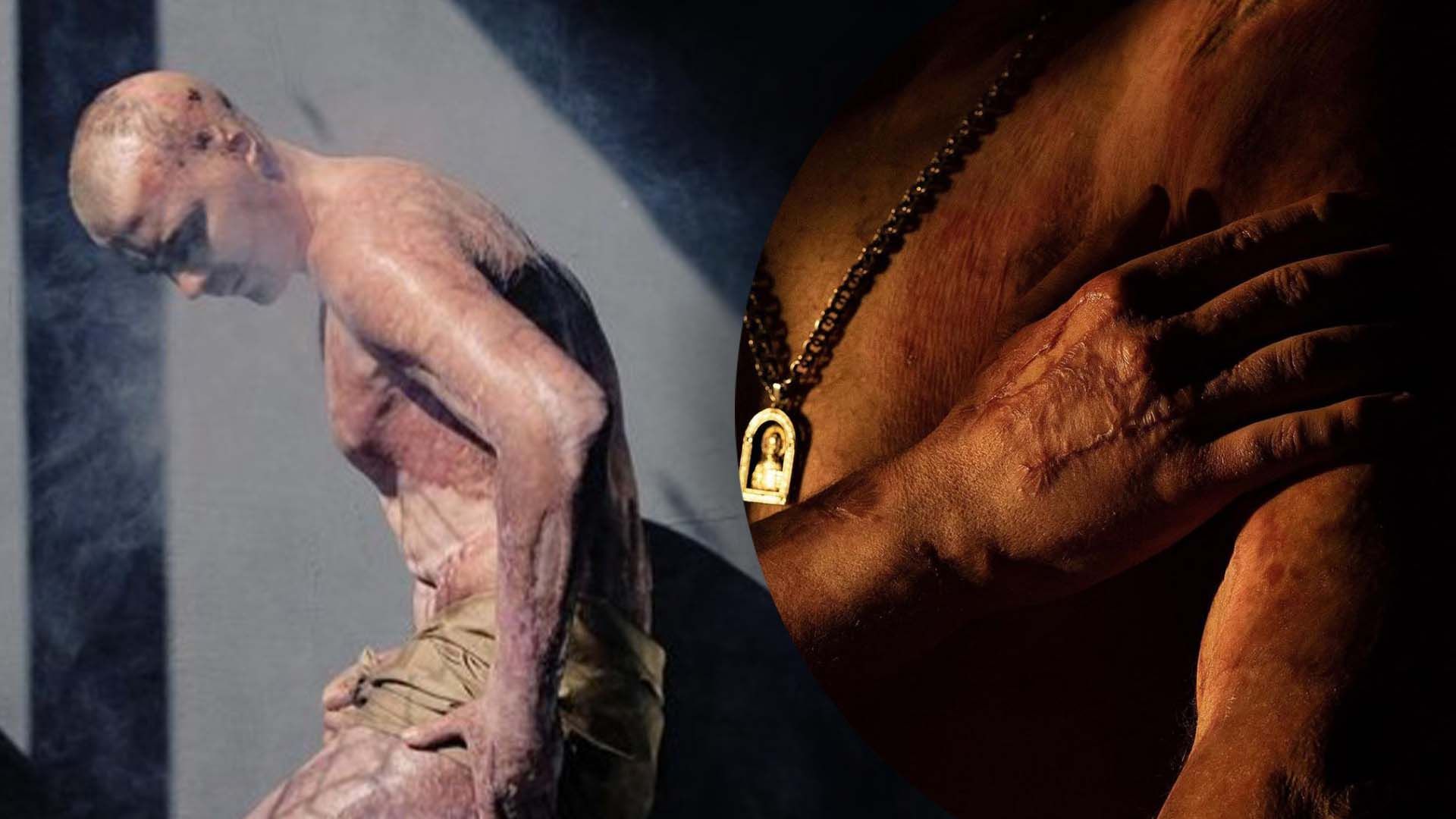 Боєць розповів, що вижив, попри важкі поранення Боєць розповів, що вижив, попри важкі поранення