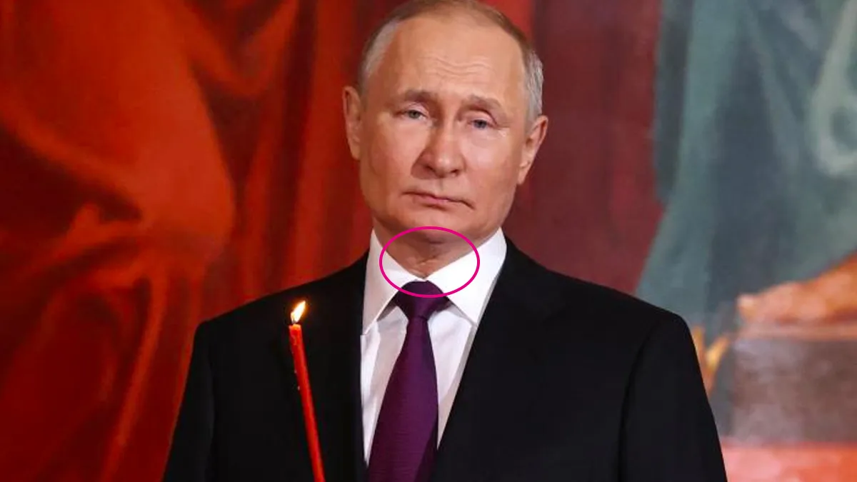 Шрам на шиї в Путіна у формі літери 
