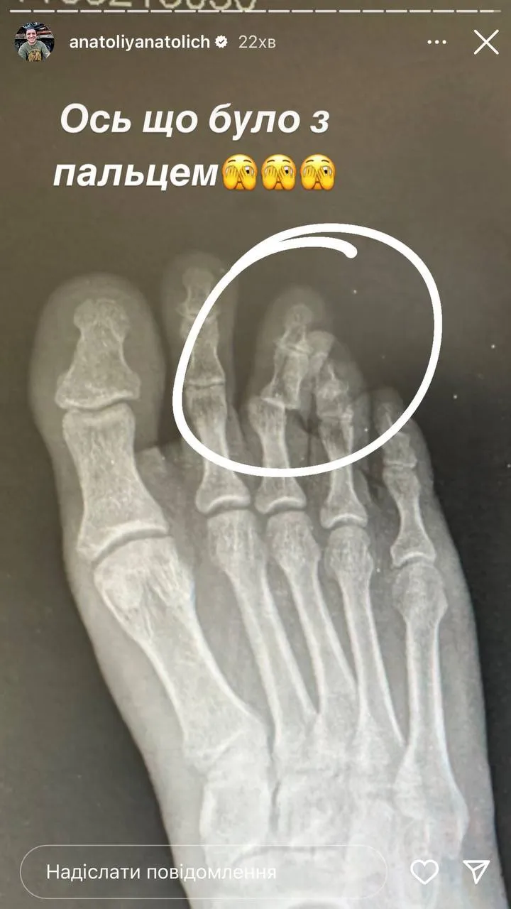 Анатолій Анатоліч злама палець на нозі