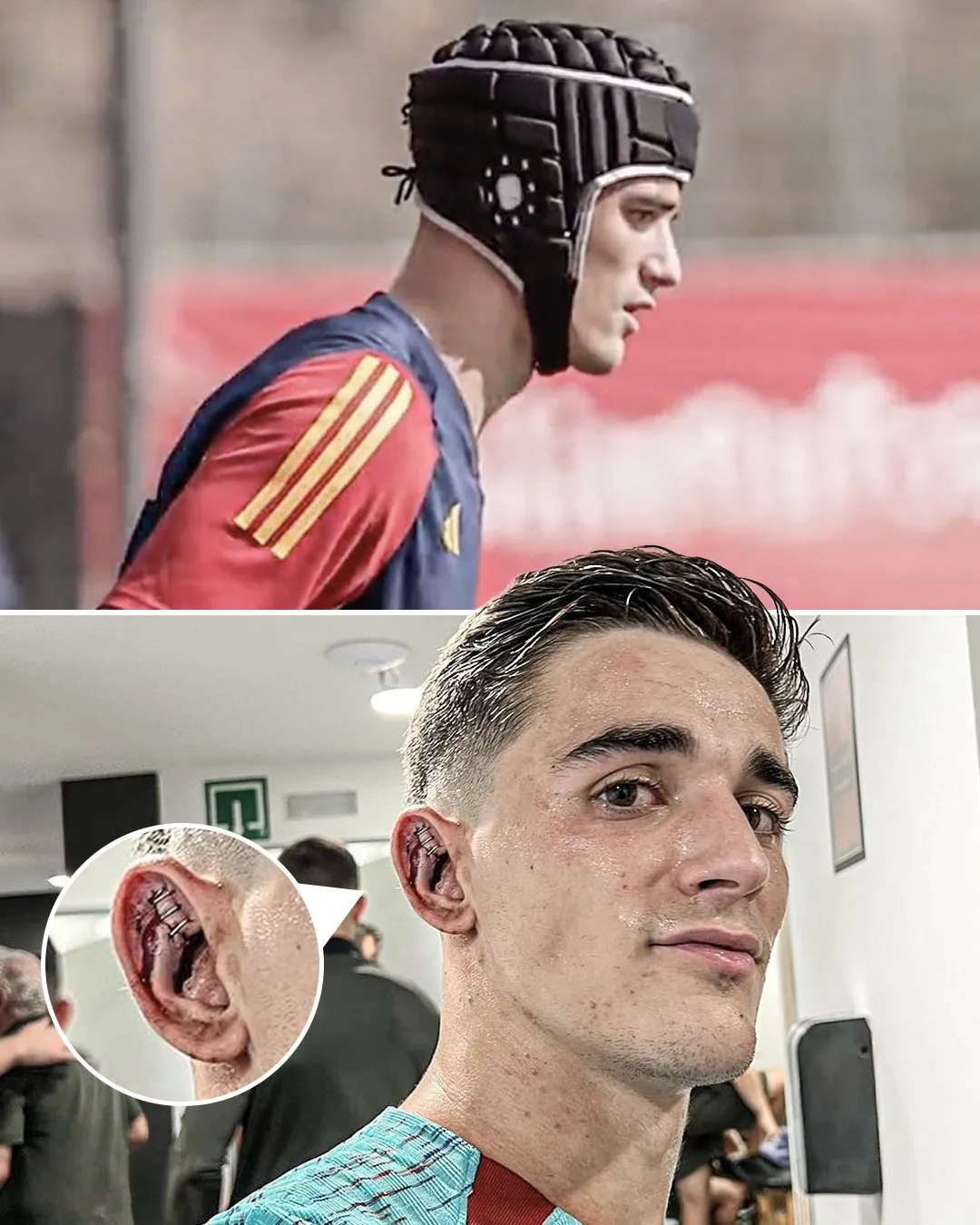 Гаві тренується у спеціальному шоломі Гаві тренується у спеціальному шоломі