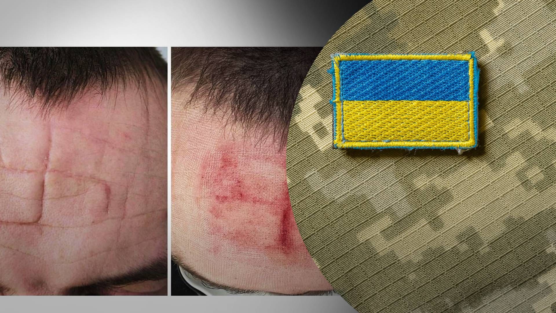 Проект "Неопалимые" опубликовал фотографии со шрамом в форме свастики на лице военного - 24 Канал