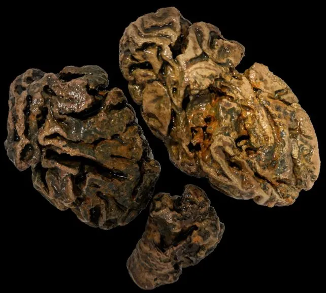 Brain fragments of a person buried in a waterlogged Victorian cemetery 200 years ago