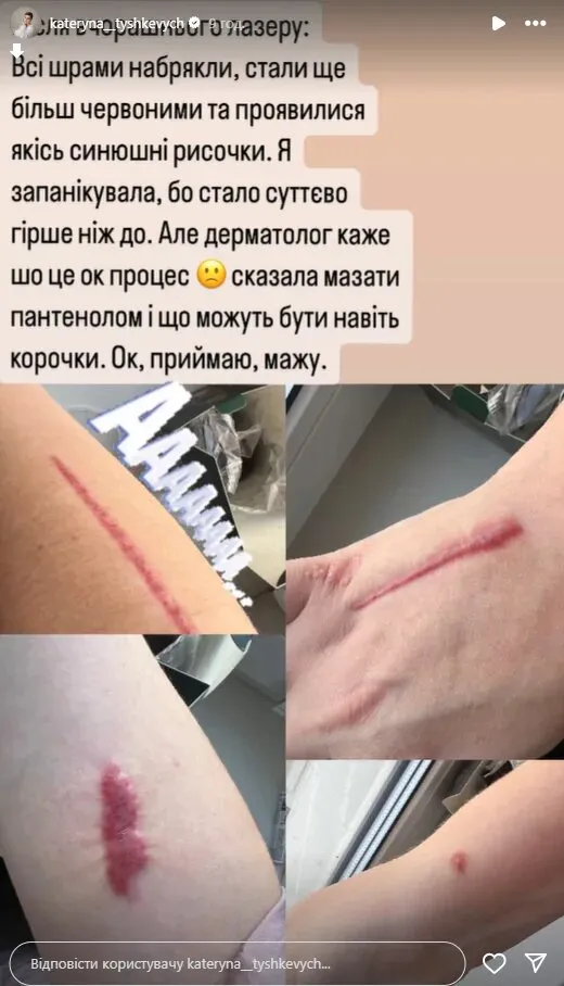 Екатерина Тышкевич показала шрамы