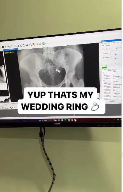 Аппарат показал обручальное кольцо
