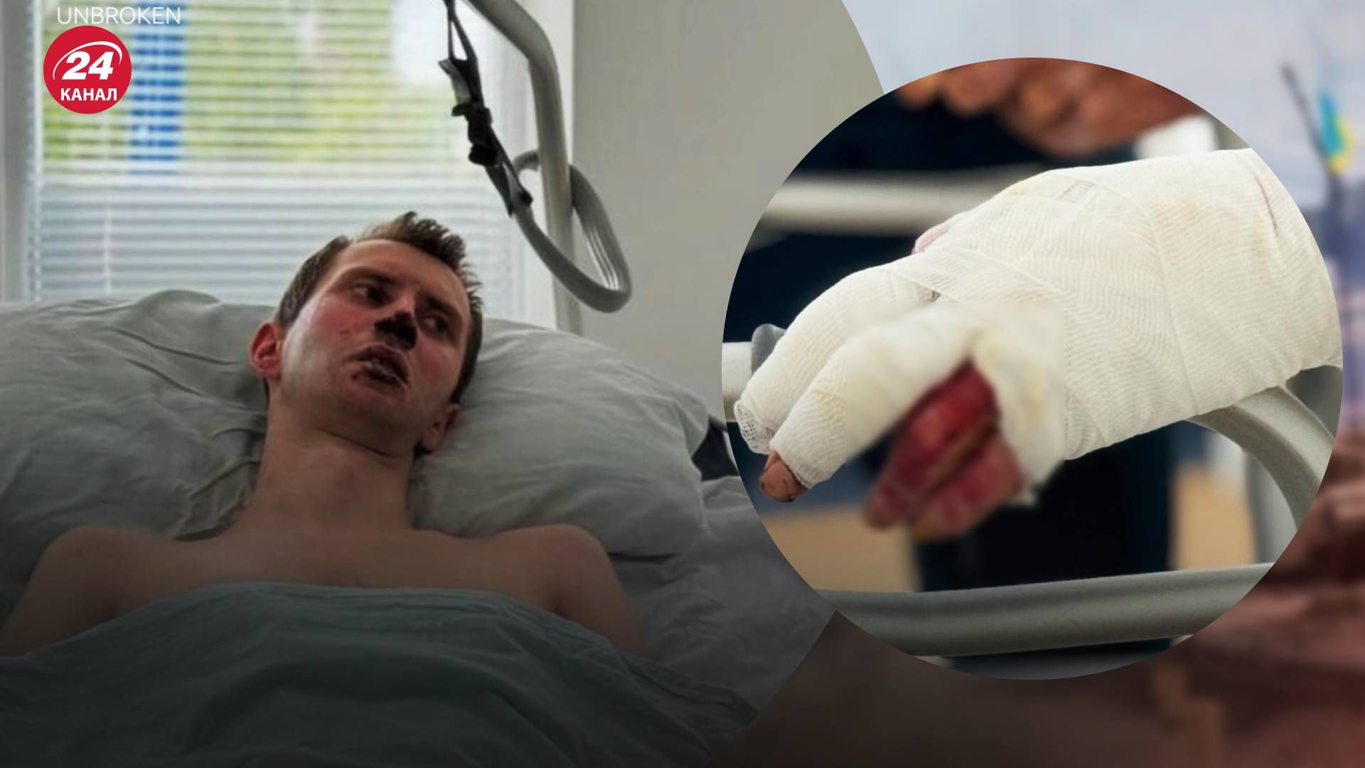 Український захисник ледь не згорів живцем - 24 Канал Український захисник ледь не згорів живцем - 24 Канал