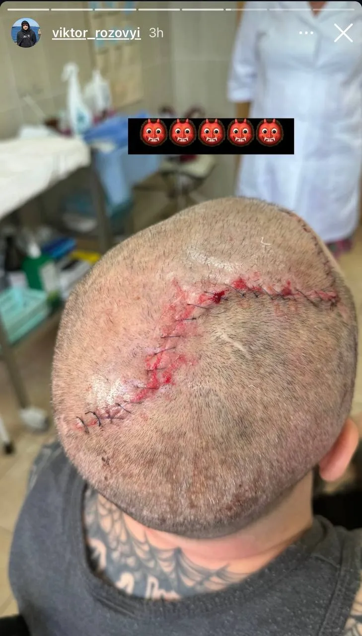 Віктор Розовий показав шрам на голові Віктор Розовий показав шрам на голові