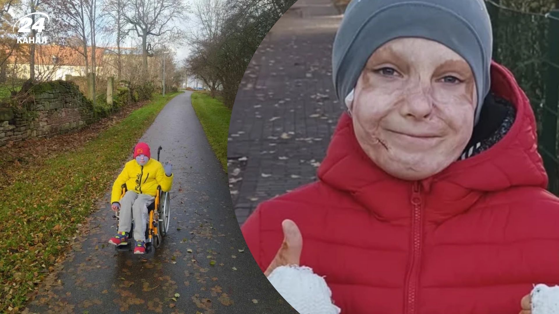 Хлопчик, що вижив після ракетного удару по Вінниці, зняв маску проти рубців, яку носив два роки - 24 Канал Хлопчик, що вижив після ракетного удару по Вінниці, зняв маску проти рубців, яку носив два роки - 24 Канал