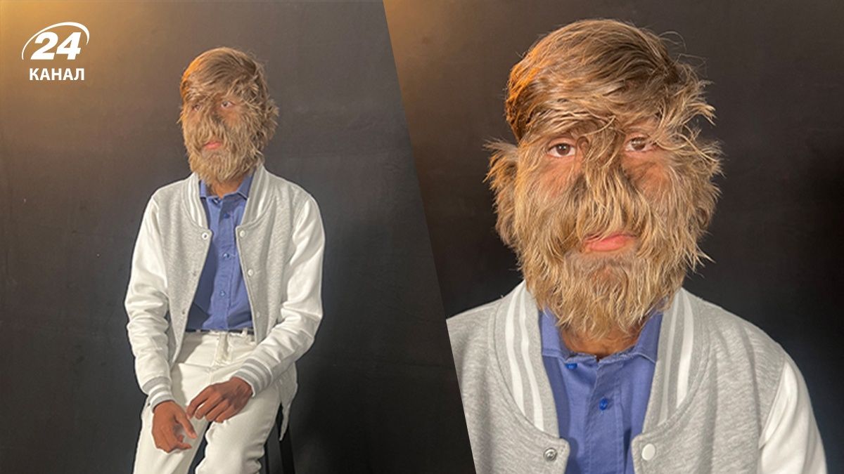 Парень с синдромом оборотня установил мировой рекорд