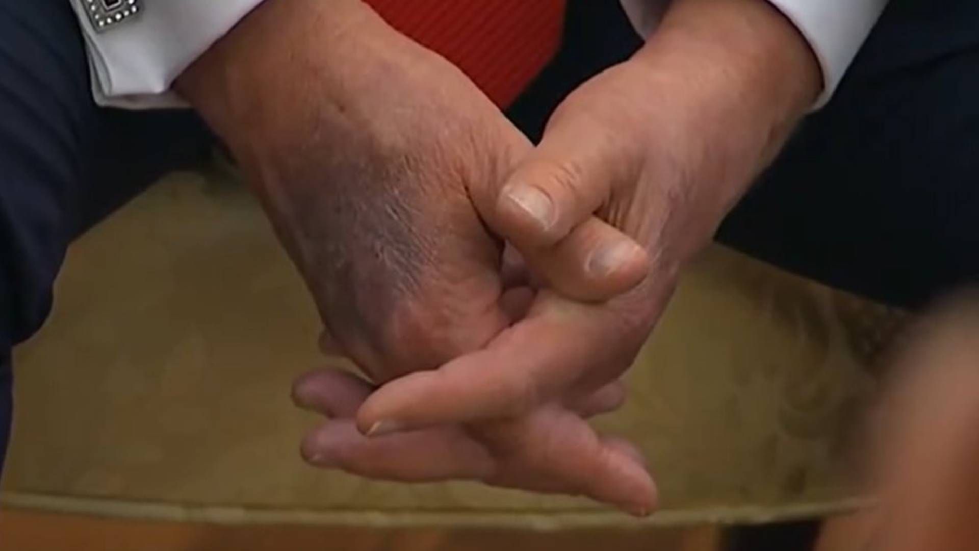 У Трампа заметили синяки на правой руке У Трампа заметили синяки на правой руке