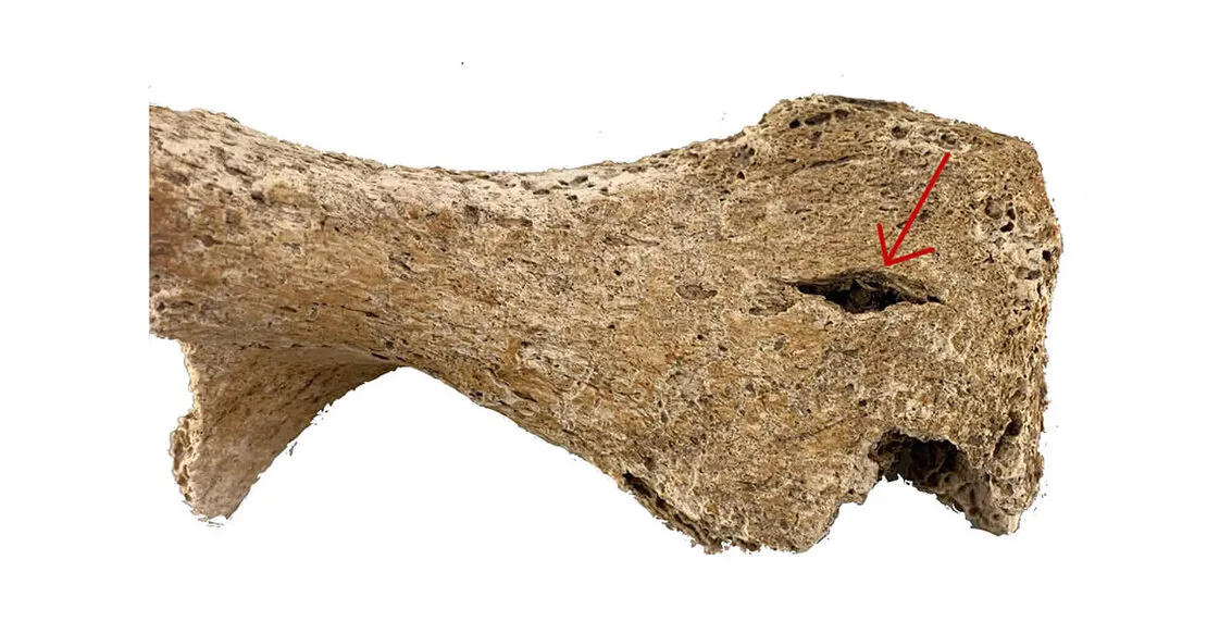 Тазова кістка з травмою