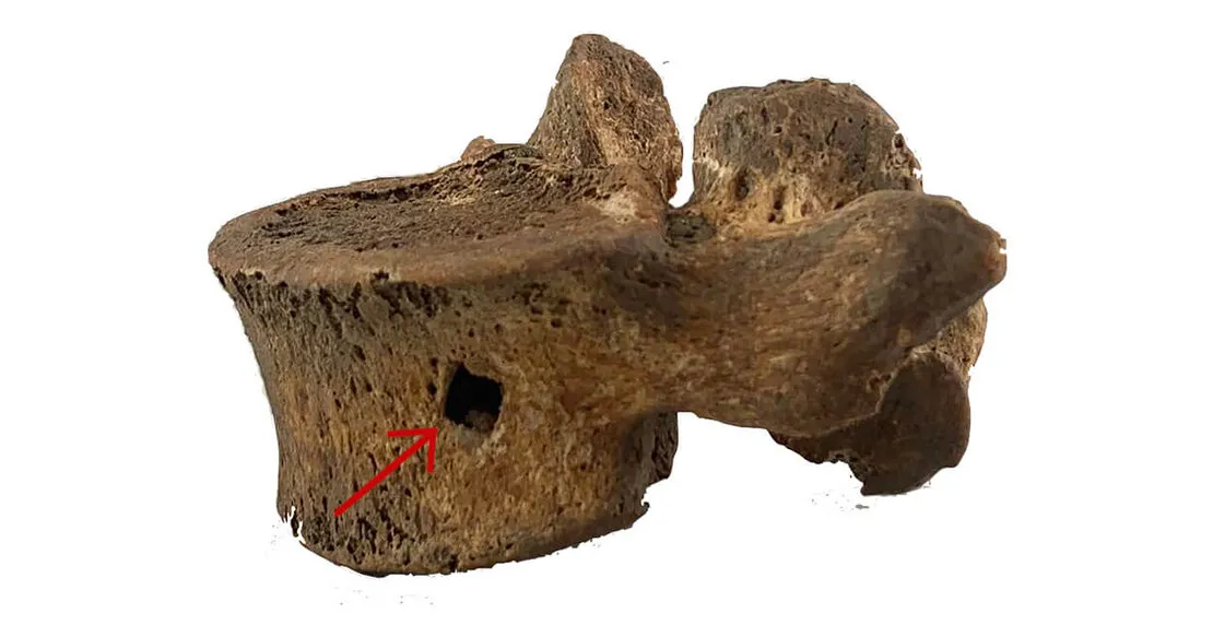 Поперековий хребець травмований залізним болтом