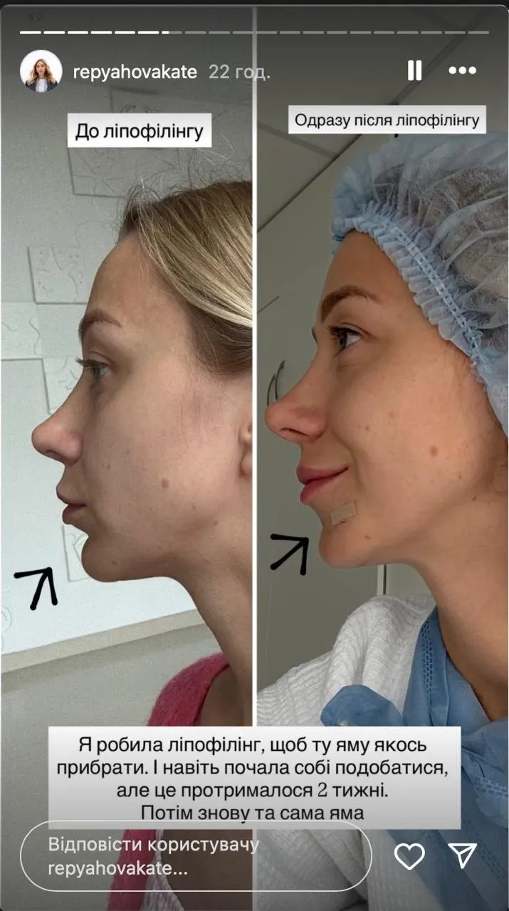 Катерина Репяхова про невдалу пластику