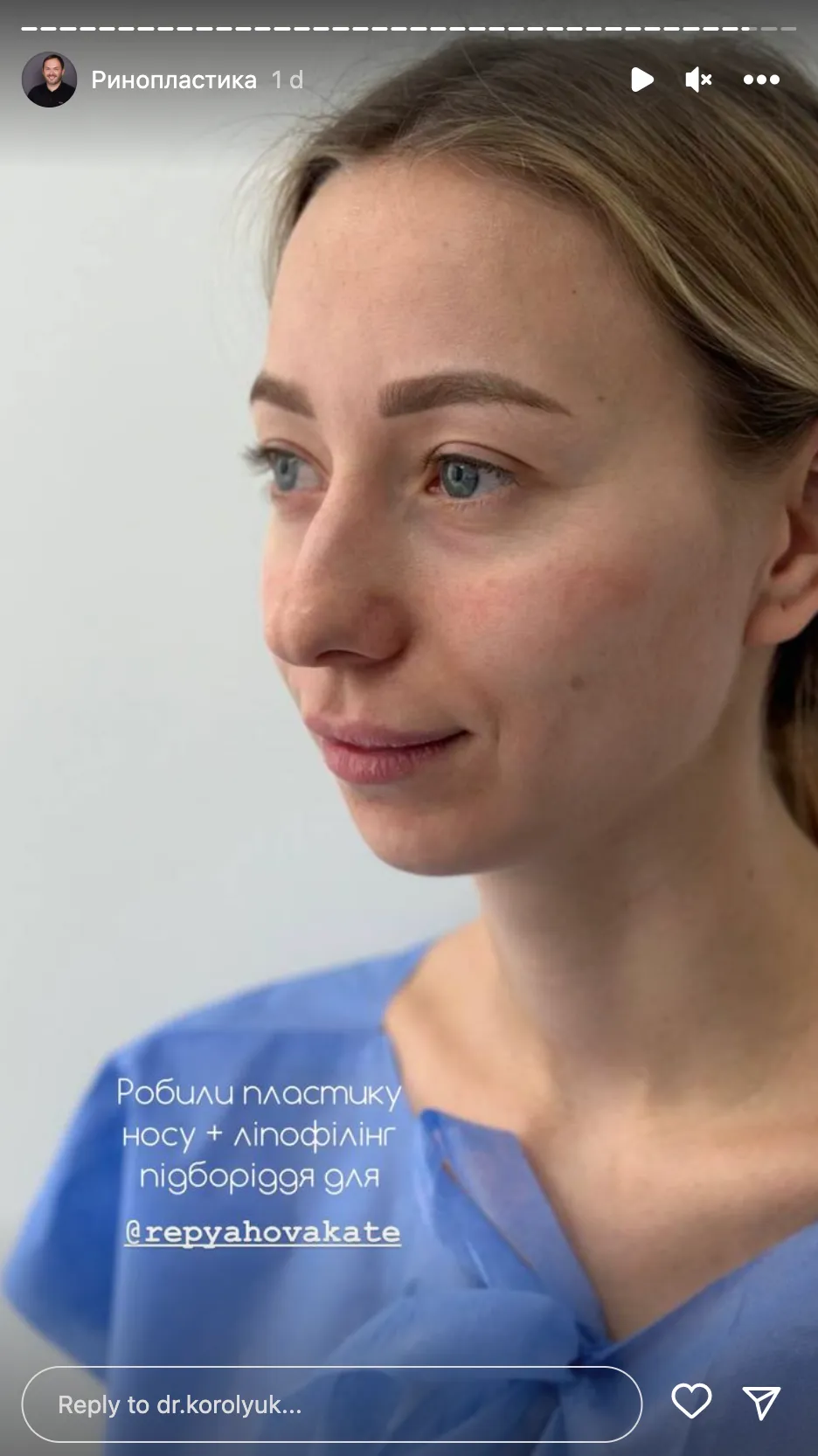 Екатерина Репяхова перед ринопластикой Екатерина Репяхова перед ринопластикой 