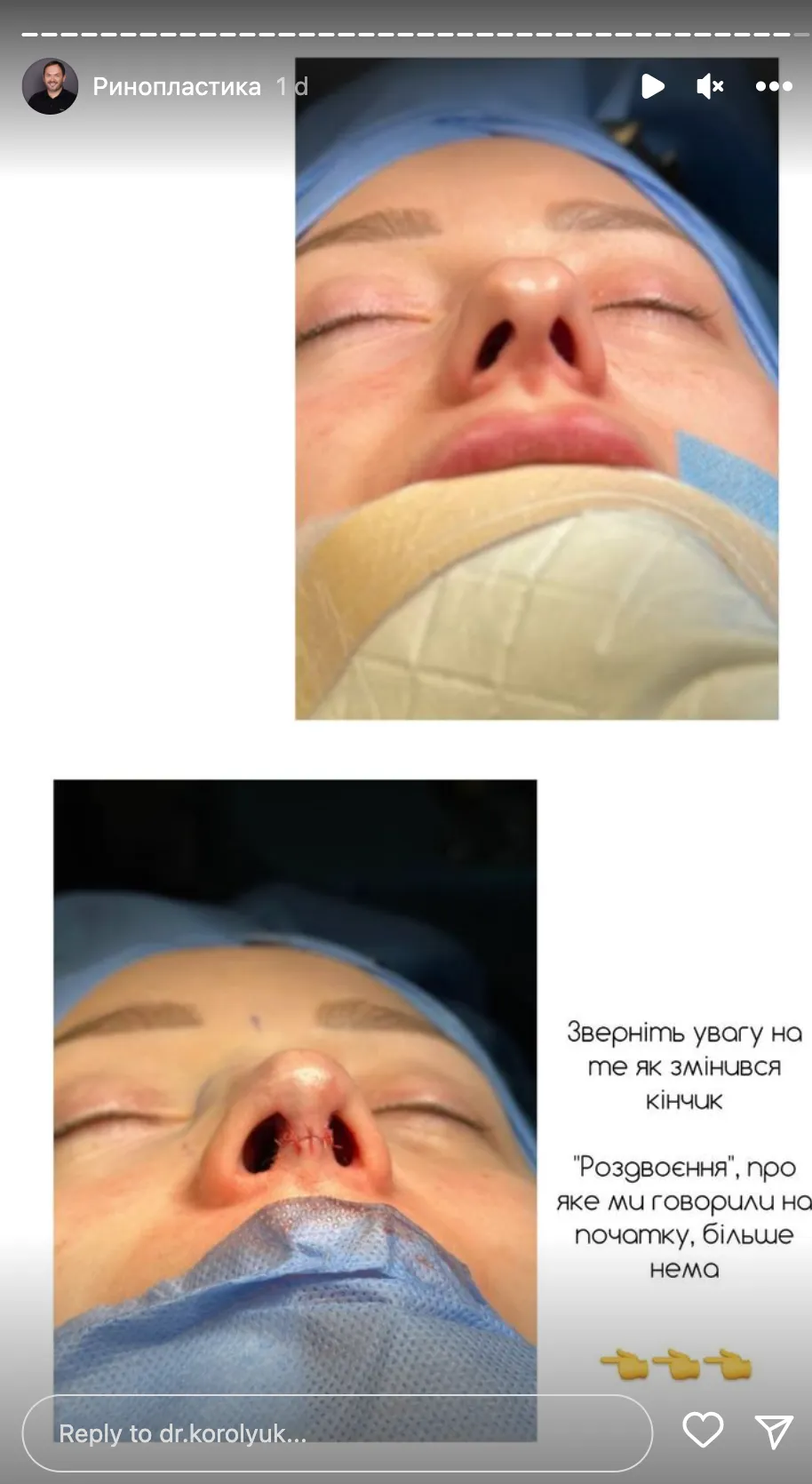 Нос Екатерины Репяховой очень изменился после операции