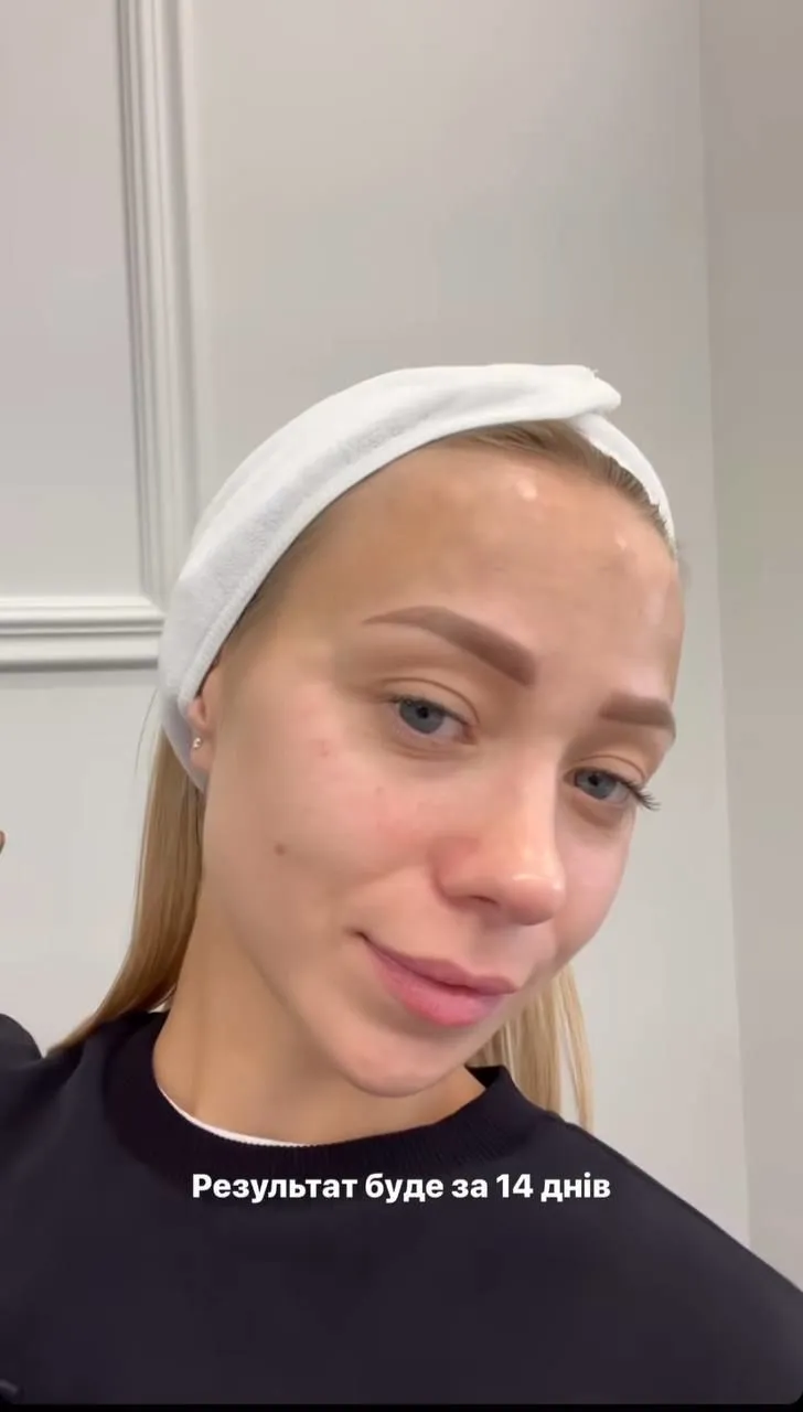 Катерина після процедури Катерина після процедури