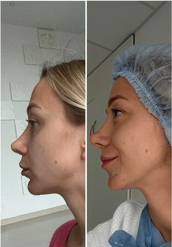 Екатерина Репяхова до и после