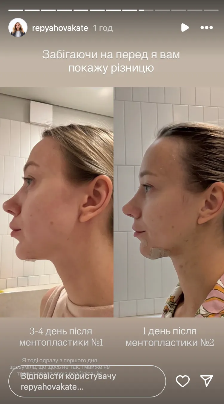 Как выглядит Екатерина Репяхова после очередной пластической операции 