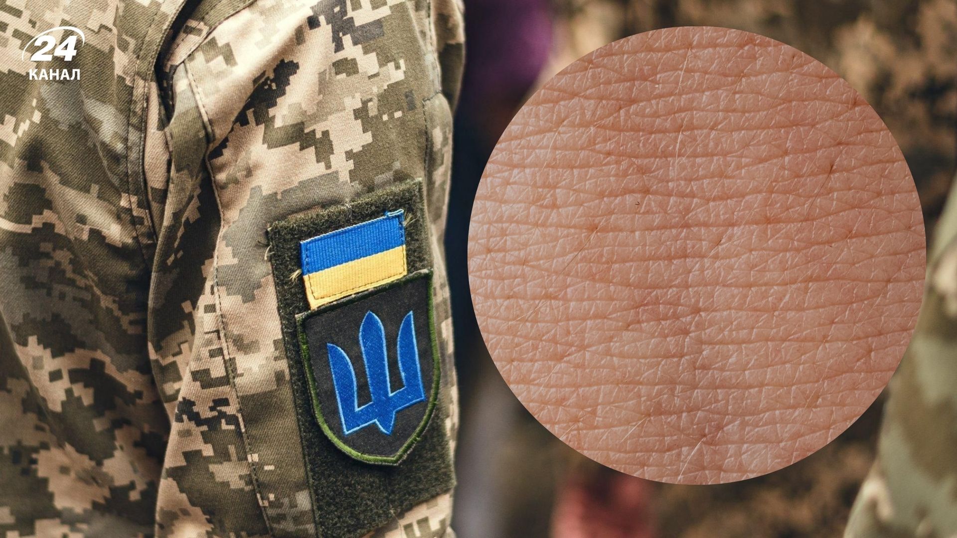 Окремі захворювання шкіри є підставою для зняття з вйськового обліку Окремі захворювання шкіри є підставою для зняття з вйськового обліку