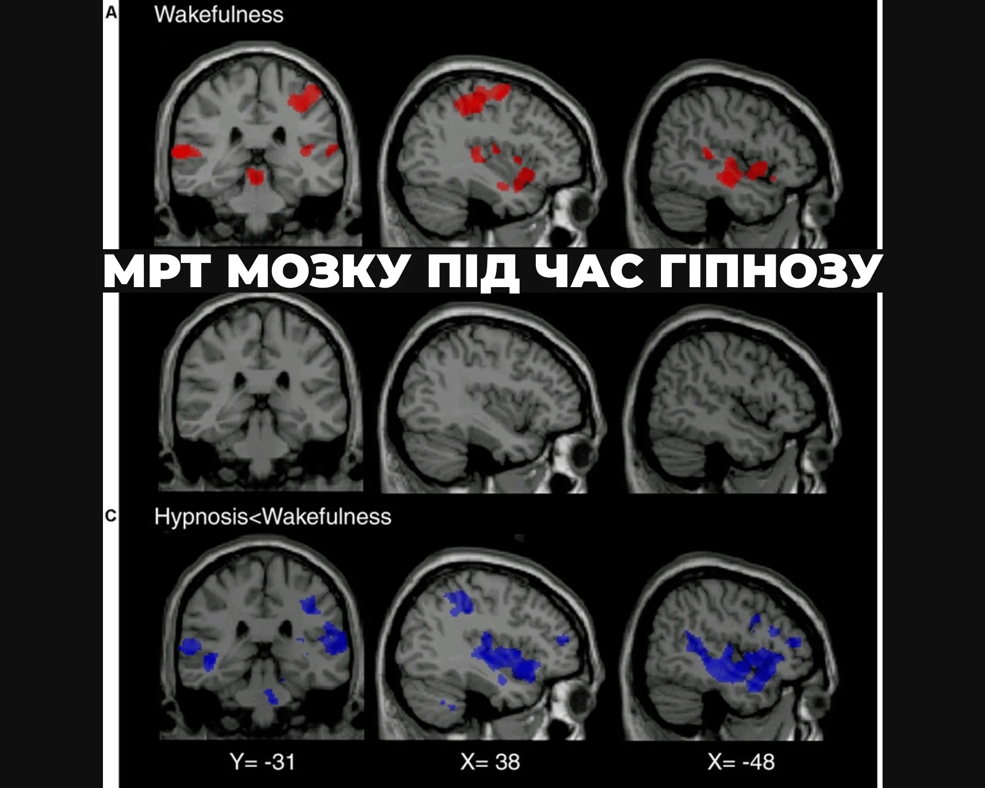 Мозок гіпноз психотерапія 