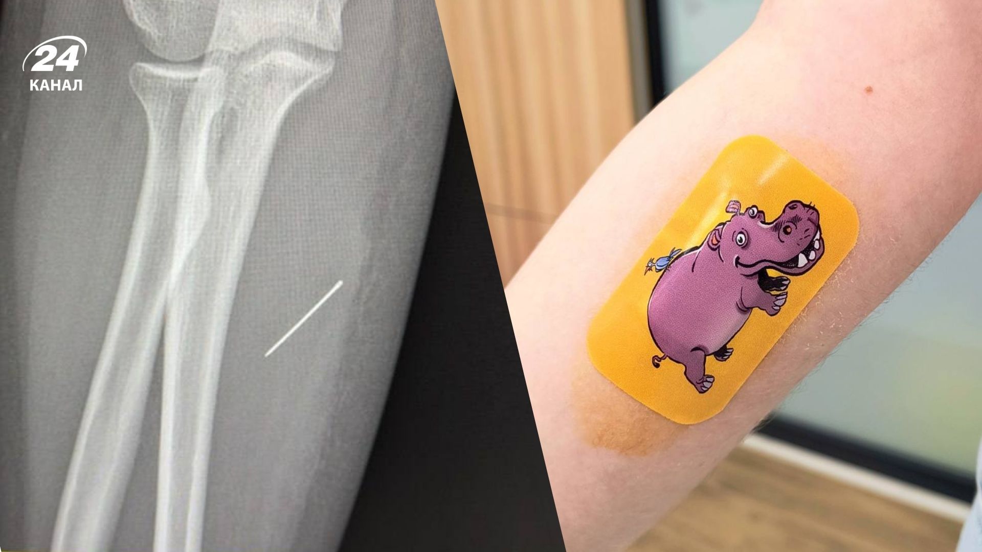 На Львівщині школярка тиждень ходила з голкою в руці - 24 Канал На Львівщині школярка тиждень ходила з голкою в руці - 24 Канал