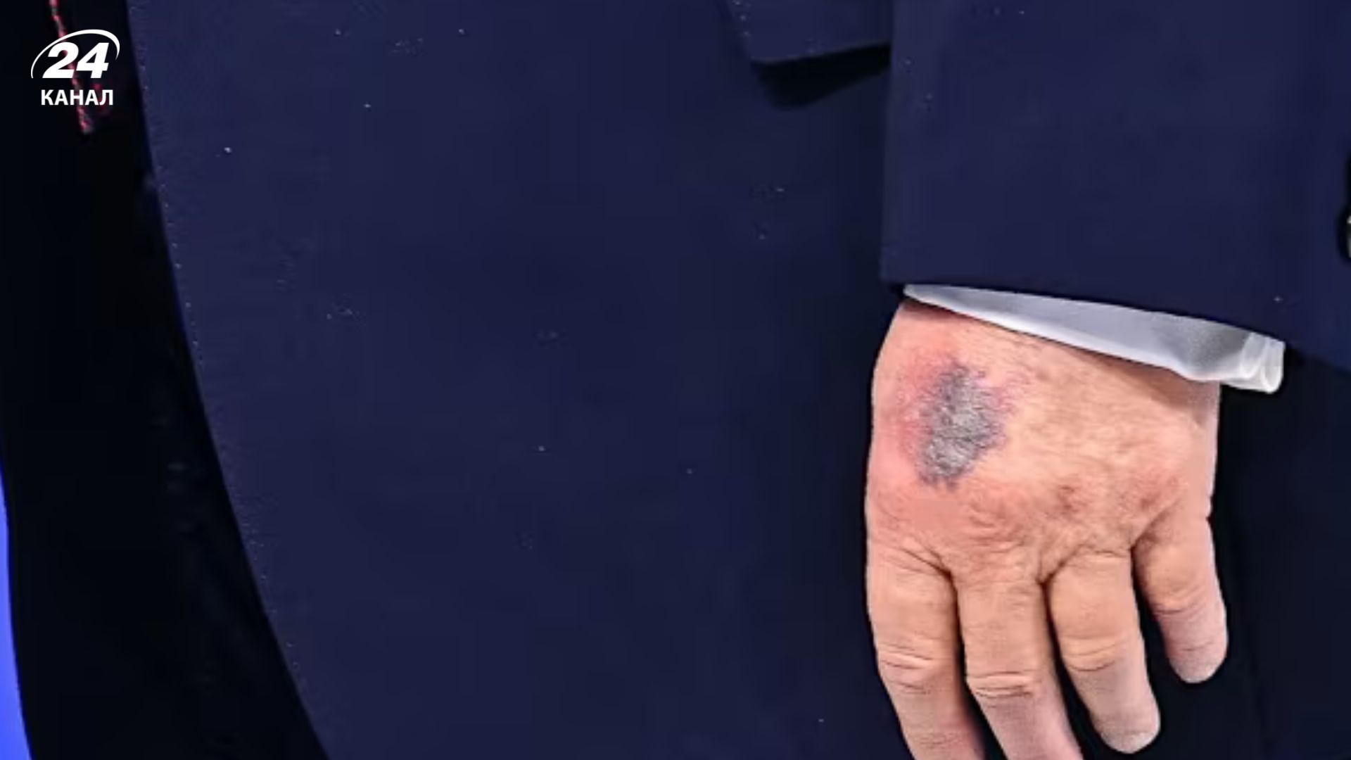 Трамп каже, що схильний до появи синців через приймання великої дози аспірину Трамп каже, що схильний до появи синців через приймання великої дози аспірину