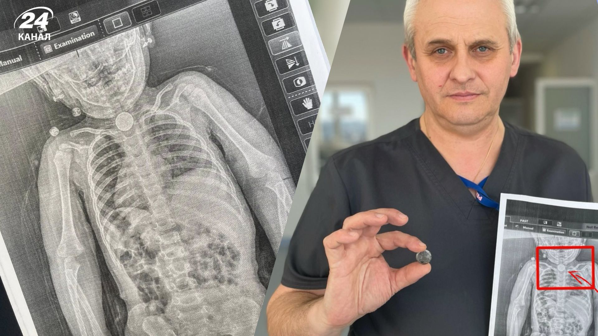 Во Львове спасли девочку, которая 3 месяца жила с батарейкой в пищеводе