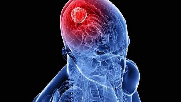 Рак мозку: ранні симптоми