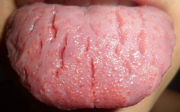 Тріщини в язику симптоми та лікування