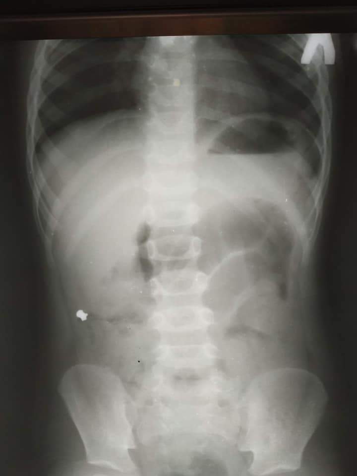 Незвичайний апендицит: у Львові прооперували хлопчика, який проковтнув кулю – фото