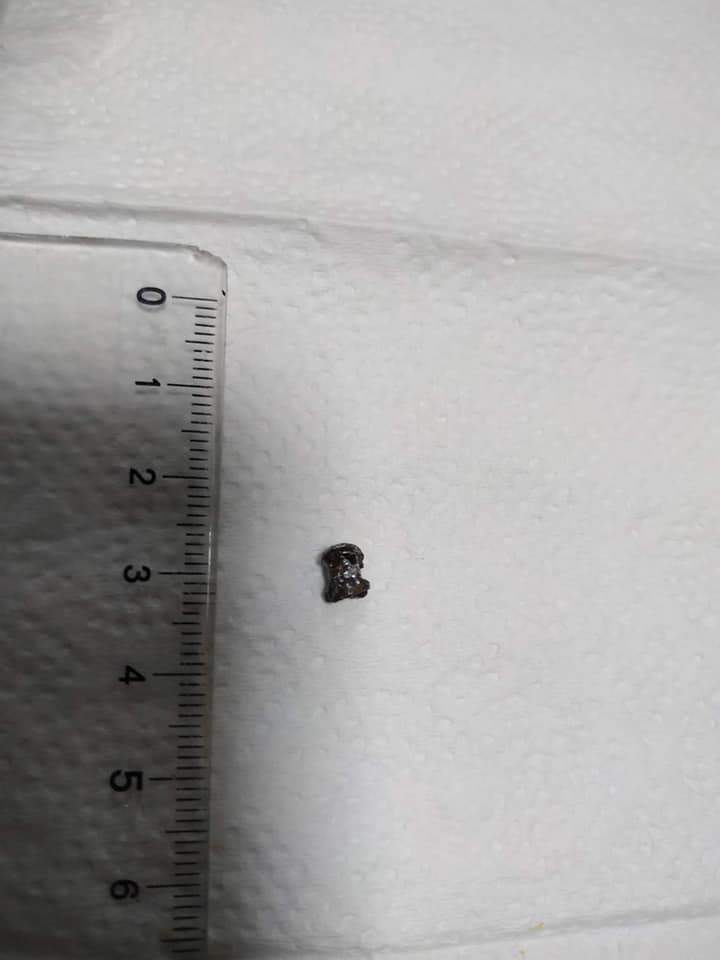 Незвичайний апендицит: у Львові прооперували хлопчика, який проковтнув кулю – фото